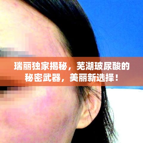 瑞丽独家揭秘，芜湖玻尿酸的秘密武器，美丽新选择！