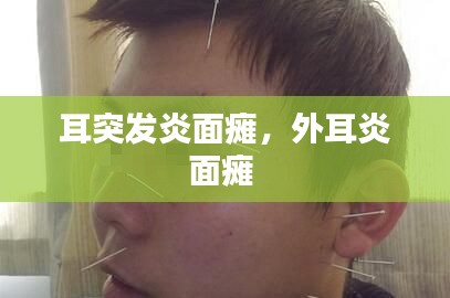 耳突发炎面瘫，外耳炎面瘫 