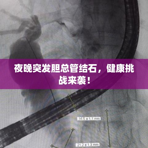 夜晚突发胆总管结石，健康挑战来袭！